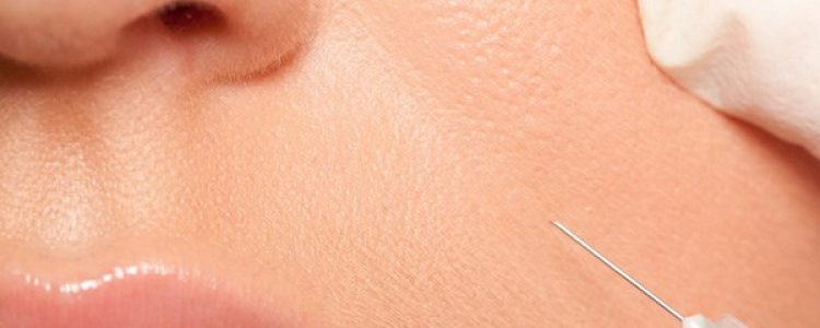 FALTENUNTERSPRITZUNG